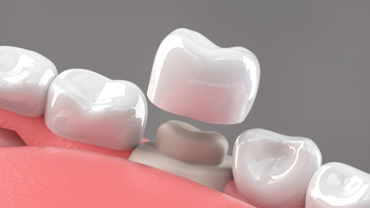 dental crowns